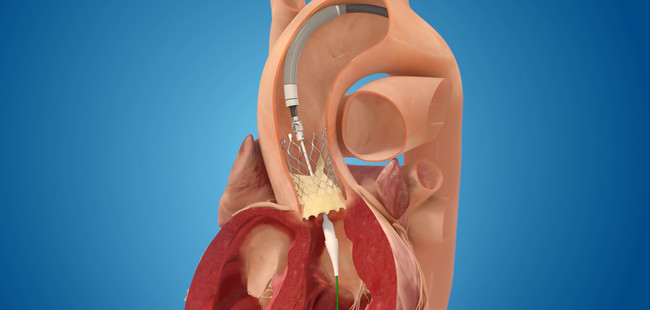 図1　生体弁を大動脈弁の位置に植込む様子