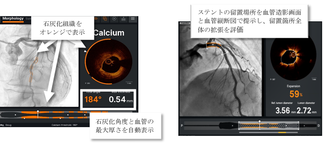 アボット 国内初のaiを搭載した循環器oct画像診断装置用 Ultreon 1 0 ソフトウェアを発売 アボットジャパン合同会社のプレスリリース