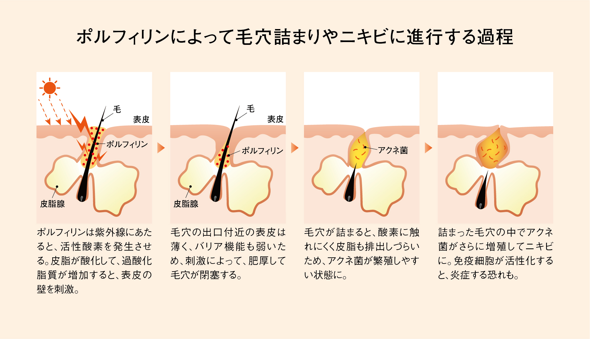 ニキビ 固くなる, つぶれないタイプのニキビ – UTEV