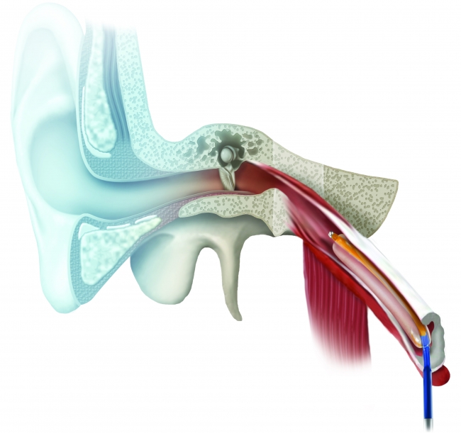 耳管内の閉塞部位をバルーン（図の右側から挿入）で拡張する様子