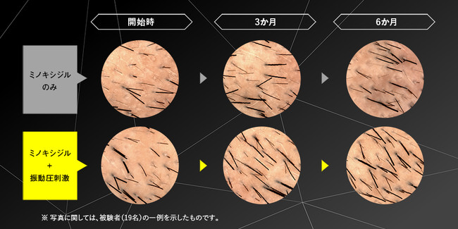 ミノキシジルのみとミノキシジル+振動圧刺激の観察部位の変化 ミノキシジルのみとミノキシジル+振動圧刺激の観察部位の変化