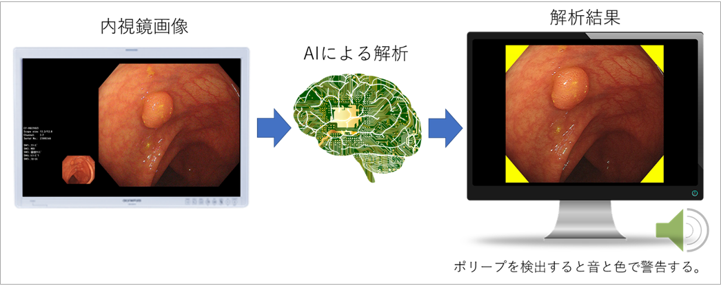 Aiを搭載した大腸内視鏡診断支援ソフトウェア第二弾 医薬品医療機器等法 薬機法 承認取得 サイバネットシステムのプレスリリース