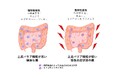 なぜ潰瘍性大腸炎は増え続けるのか？ ― 食生活の変化と腸内水素の減少に着目した新仮説 ―