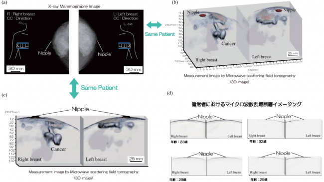 図８：マイクロ波マンモグラフィの臨床研究結果. (a)X線マンモグラフィ画像と(b,c)マイクロ波マンモグラフィによる測定画像の比較(高濃度乳房、55歳、右胸がん腫瘍). (d)健常者のマイクロ波マンモグラフィ画像.
