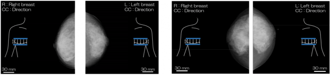 図3：高濃度乳房患者のX線マンモグラフィ画像. 