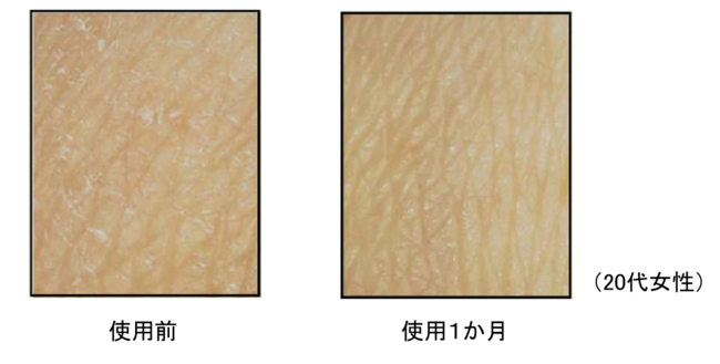 図４．コメエキスNU を配合した美容液による手背の肌荒れの予防効果（代表例）