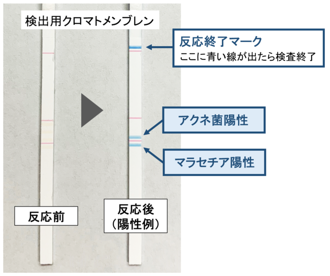 図3　アクネ菌・マラセチア陽性例