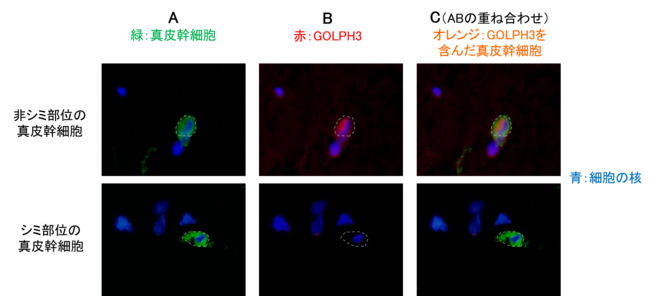 図４ 非シミ部位とシミ部位の皮膚切片の真皮幹細胞におけるGOLPH3の発現