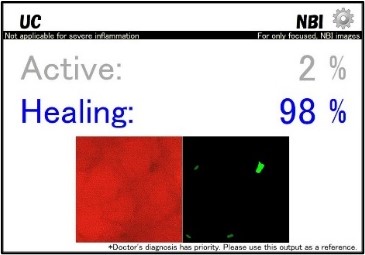 国内初の薬事承認を取得した潰瘍性大腸炎評価用ai技術 Aiを搭載した内視鏡画像診断支援ソフトウェア Endobrain Uc を発売 大腸 内視鏡検査中 リアルタイムに炎症活動性評価をサポート オリンパス株式会社のプレスリリース