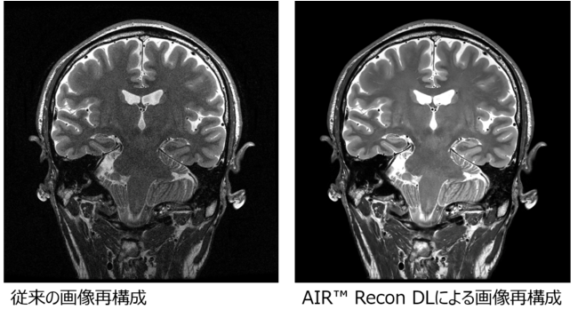 GEヘルスケア・ジャパン、新プラットホーム「AIR™ IQ Edition」を全MRI