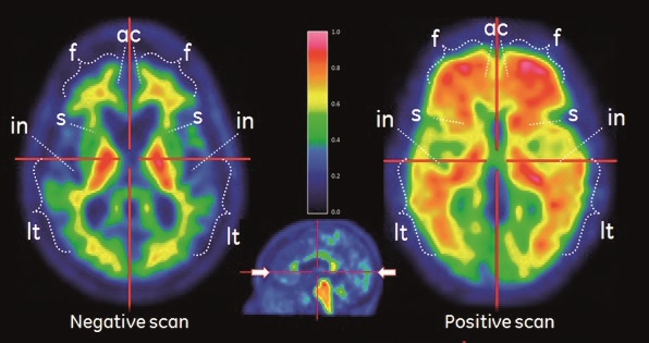 アミロイドβ　陰性画像（negative scan）と陽性画像(positive scan)