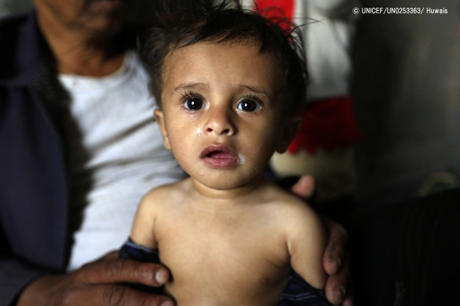 栄養不良に苦しむ生後9カ月の男の子。(2018年10月30日撮影) (C) UNICEF_UN0253363_Huwais