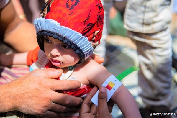 マアリブにある国内避難民キャンプで、上腕計測メジャーを使って栄養不良の検査を受ける1歳のアルワちゃん。(2020年3月撮影) © UNICEF_UNI337479_