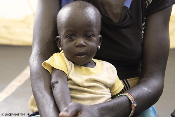ピボールにある栄養センターで重度の急性栄養不良と診断された生後9カ月のマーサちゃん。栄養不良の長期的な影響を防ぐため、栄養プログラムを受けている。(2020年9月撮影) © UNICEF_UNI374941_Ryeng