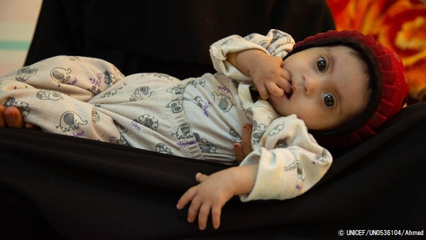 栄養不良で首都サヌアの病院に入院している、生後10カ月のハウラちゃん。(2021年10月10日撮影) © UNICEF_UN0536104_Ahmed