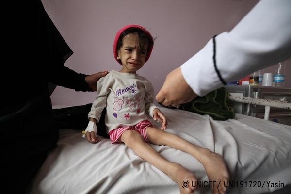 栄養不良に陥り、身体が弱って歩くことのできない2歳8カ月の女の子。体重が7キロまで落ちており、病院で治療を受けている。© UNICEF_UNI191720_Yasin