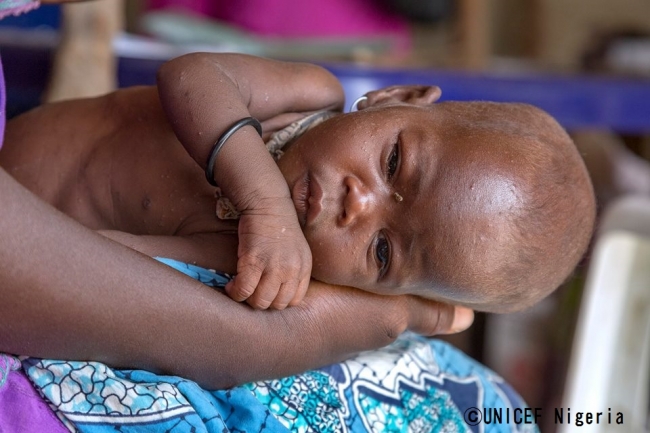 ユニセフが支援する保健センターで治療を受けている、重度の急性栄養不良の男の子。（ナイジェリア・ボルノ州の避難民キャンプ）※本文との直接の関係はありません。　© UNICEF_Nigeria