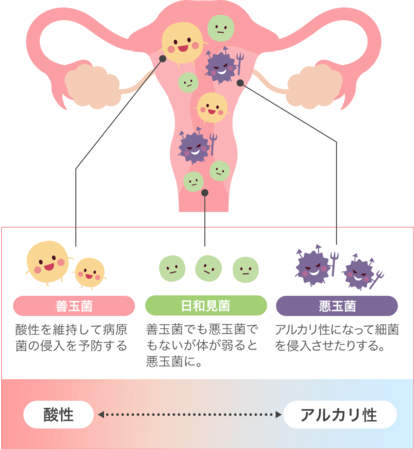 子宮内フローラ