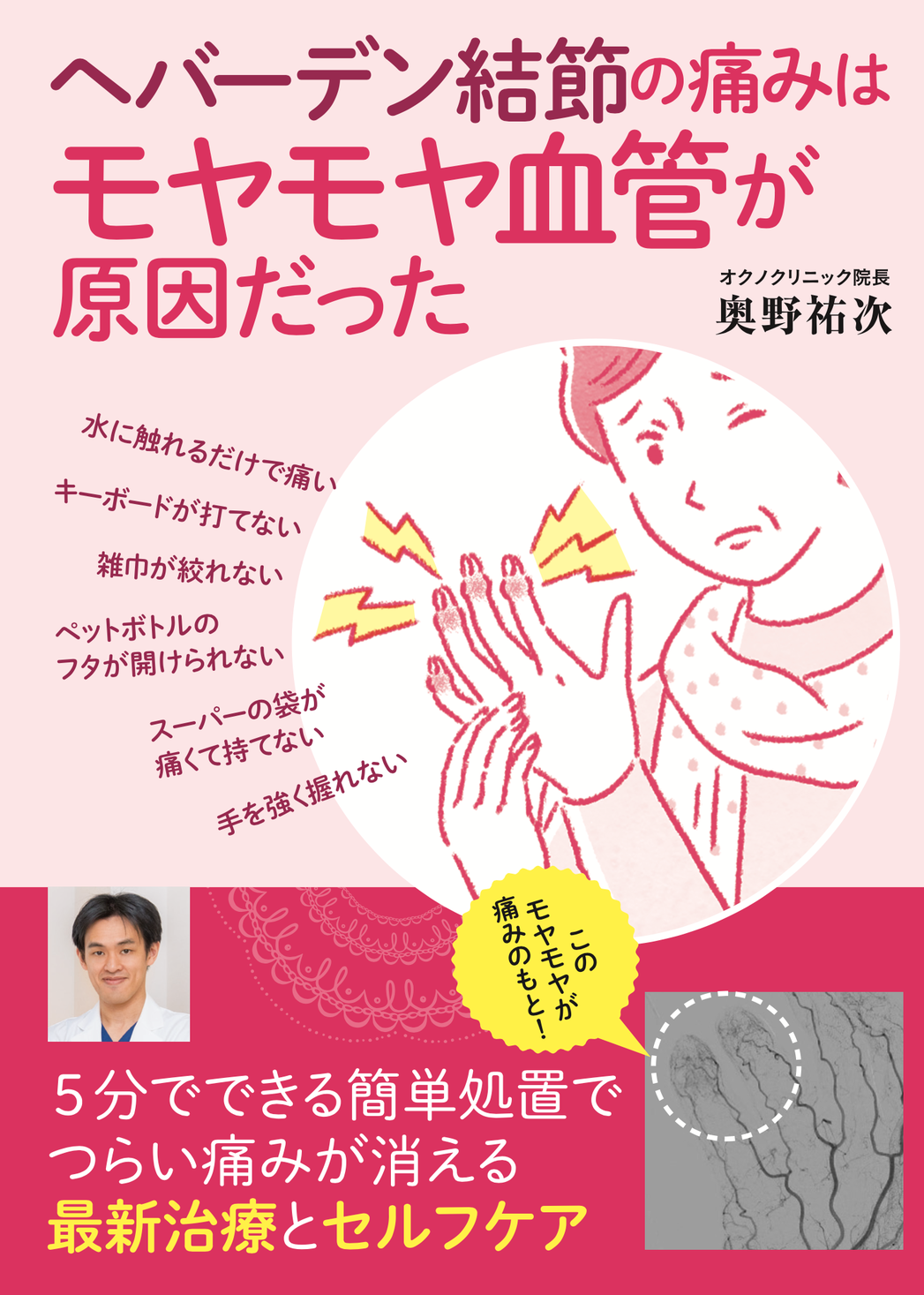 50歳の28 60歳の35 70歳の50 以上が発症経験あり モヤモヤ血管による痛み へバーデン結節 の最新治療とセルフケア へバーデン結節 の痛みはモヤモヤ血管が原因だった 2月22日発売 医療法人社団祐優会のプレスリリース