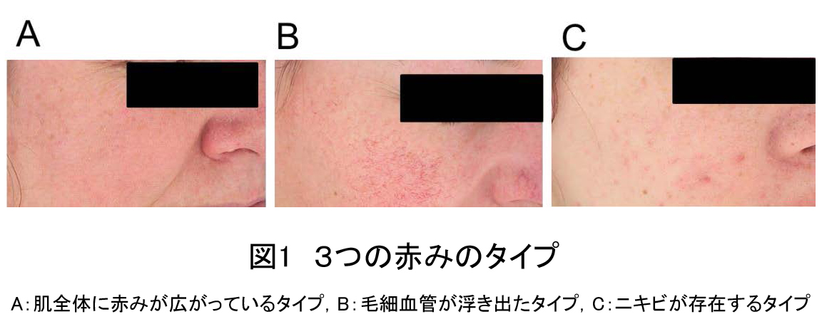 資生堂 顔の赤みの新たな発生要因を解明 赤み対応スキンケア製品の開発に応用 株式会社資生堂のプレスリリース