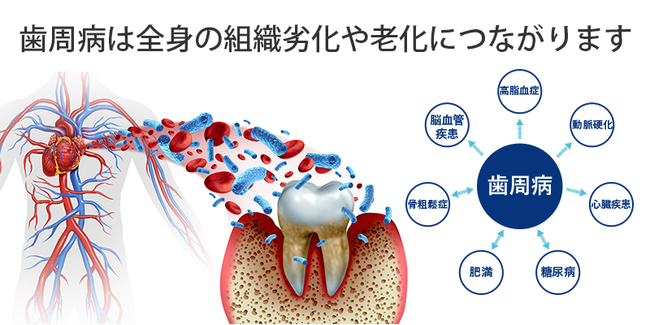 歯周病は全身の組織劣化や老化につながります