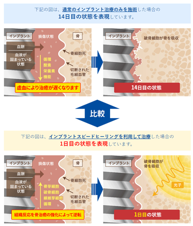 インプラントスピードヒーリングを利用した場合の比較