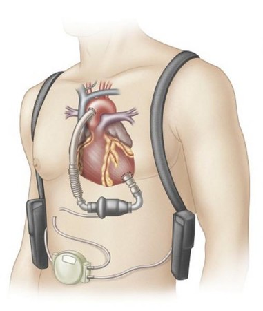 世界の心臓補助装置市場― 製品別：(大動脈内バルーンポンプ、補助人工心臓、{左心室補助装置、右心室補助装置、両心室アシストデバイス}トータル人工心臓（TAH）)、地域別予測2025年