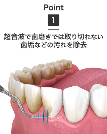 超音波の力で、歯磨きでは取り切れない歯垢や汚れをしっかりと除去