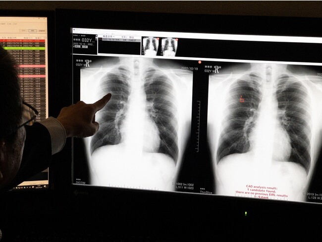 「AI支援胸部がん検診読影システム」を活用した読影の様子