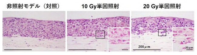 炭素線（10Gy、20Gy）照射後5日目の3D口腔がんモデルの病理組織像。右下挿入の高 倍率写真は、照射の影響によるアポトーシス（細胞死）を引き起こした細胞