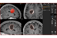 Brainlab® ElementsにAI技術を新たに搭載
