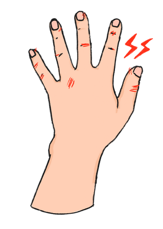 手荒れにより食中毒のリスクが増加 手荒れにより食中毒のリスクが増加