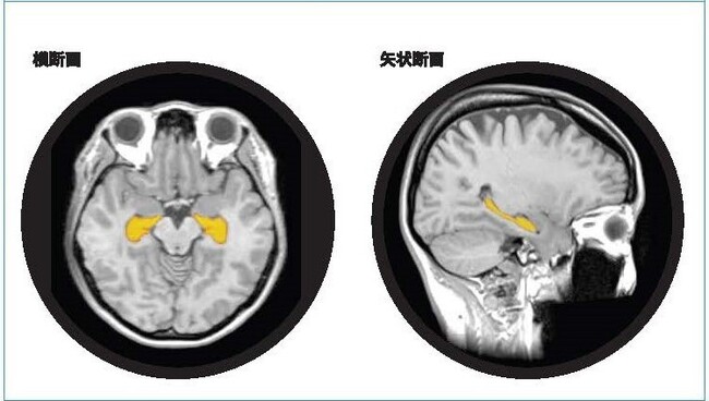 <40代女性の海馬解析画像(例)> <40代女性の海馬解析画像(例)>