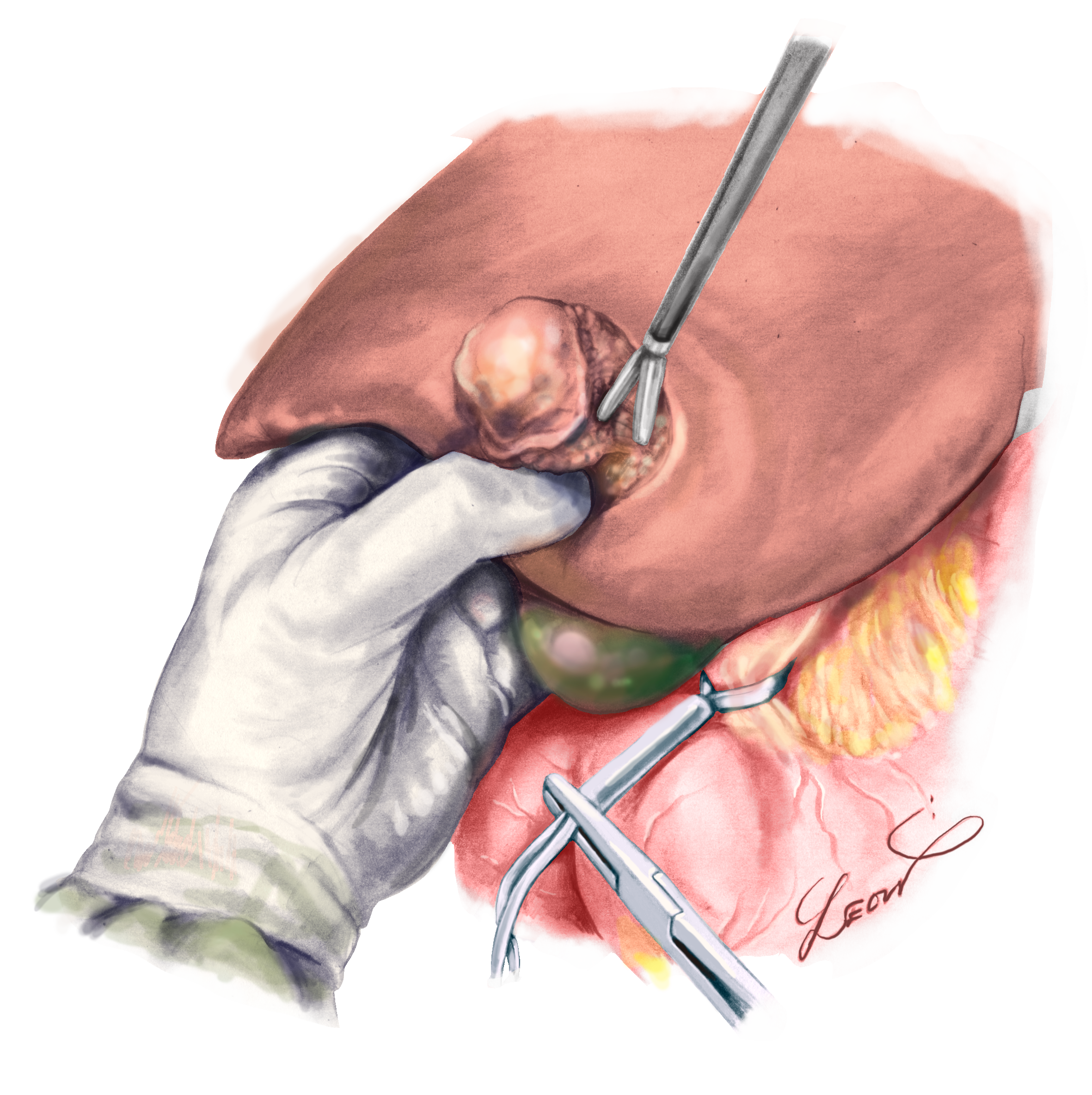 医学医療を可視化するメディカルイラストレーションを身近に L Kメディカルアートクリエイターズ株式会社 間もなく1周年 Lkmacのプレスリリース