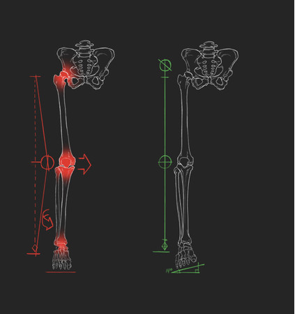 （左）内反ウェッジなし（右）Body Geometry内反ウェッジあり