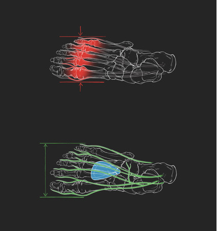 （上）中足骨のサポートなし（下）Body Geometry中足骨ボタンあり
