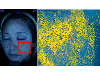 にんじんジュースを継続摂取した結果、7人中6人の隠れジミが平均13.4％改善傾向に「β-カロテン継続摂取...