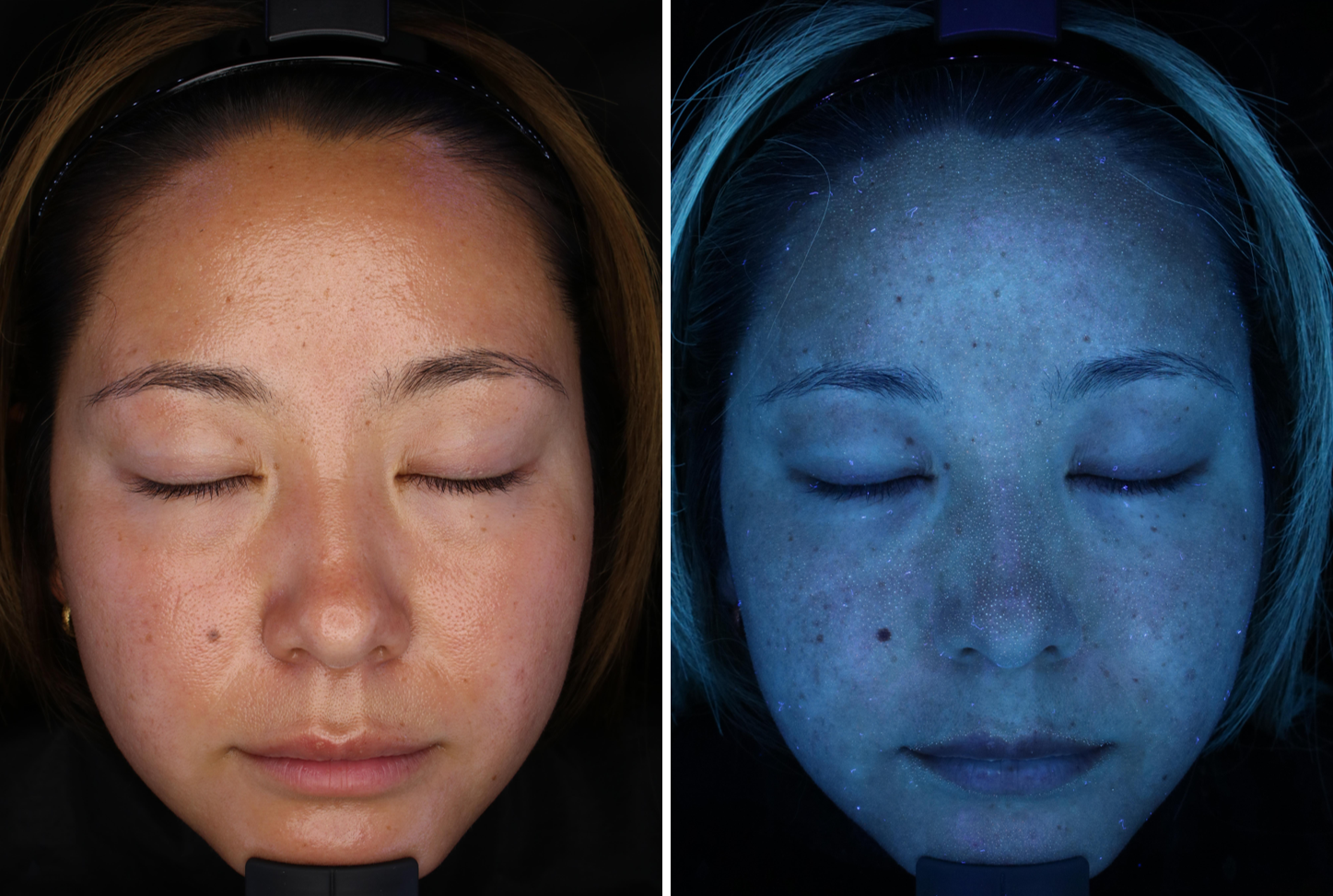 皮膚科医が夏終わりのサーファーの紫外線肌ダメージを診断 酷暑の後の「隠れジミ」に関するモニター調査※1結果を公開 シミ予備軍をシミにしないための対策とは？