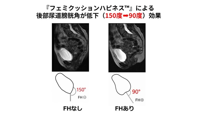 銀座リプロ外科、第28回日本女性骨盤底医学会で演題「フェミクッションハピネス(TM)装着による骨盤底の変化-MRIによる解析-」を発表