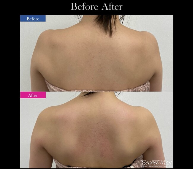 【大賞受賞】“姿勢で変わるドレス姿” ブライダル特化整体×エステをCYANが開始！天使の羽コース！