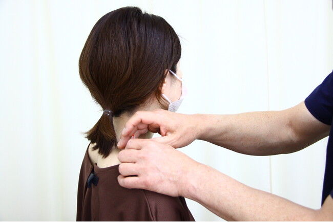 鍼治療×高濃度ビタミンC点滴による新しい花粉症治療