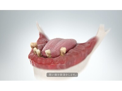 入れ歯の時代が終わる。歯科界に革命をもたらす新治療「オールオンX」のイメージCG完成。
