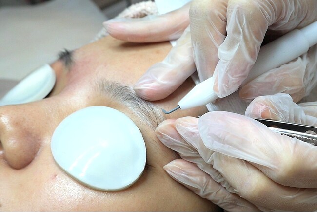 ■【導入から丸１年】リゼの『ニードル脱毛（針脱毛）』、男女ともに来院者が増加白い毛・硬毛化ほか 確実な “永久脱毛効果” で需要拡大　～　お笑い芸人「かまいたち」によるニードル脱毛の体験動画が公開！