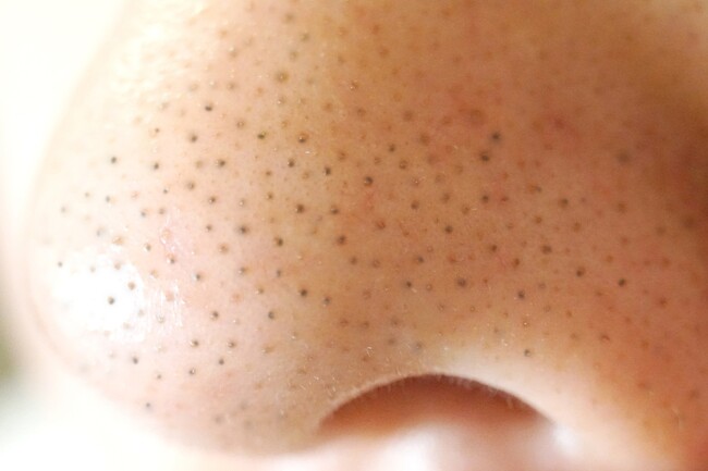 ■【秋の毛穴トラブル急増に注意】夏のダメージが押し寄せる「秋毛穴」の二大原因と対策を医師が解説!《「毛穴ケア」「毛穴レス」の美容ハック》あなたの毛穴はどれ?『毛穴タイプ別リスト』を公開|リゼクリニック