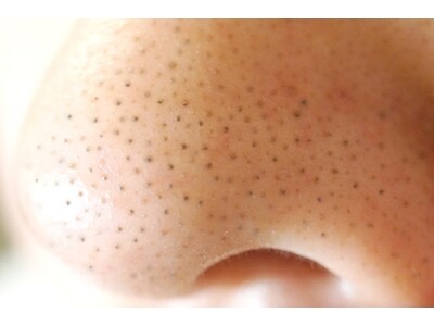 ■【秋の毛穴トラブル急増に注意】夏のダメージが押し寄せる「秋毛穴」の二大原因と対策を医師が解説！《「毛穴ケア」「毛穴レス」の美容ハック》あなたの毛穴はどれ？『毛穴タイプ別リスト』を公開｜リゼクリニック