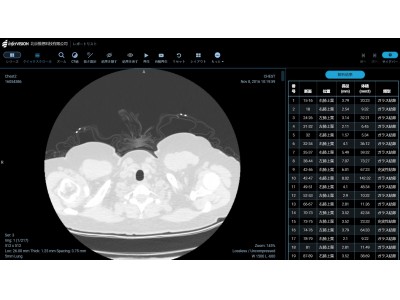 ＣＶイメージングサイエンス及び医療法人社団ＣＶＩＣは、Infervision（北京推想科技有限公司）と医用画像診断に関わるAI診断アシストシステム開発に関するアドバイザリー契約を締結。