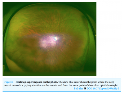 【世界初】広角眼底画像からAIを用いて特発性黄斑円孔判定でAUC99%を達成