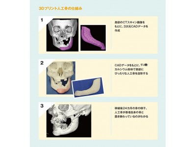 世界初、 ３Dプリンター成形による、患者自身の骨に癒合し、同化する人工骨（CT-Bone）の承認を取得！