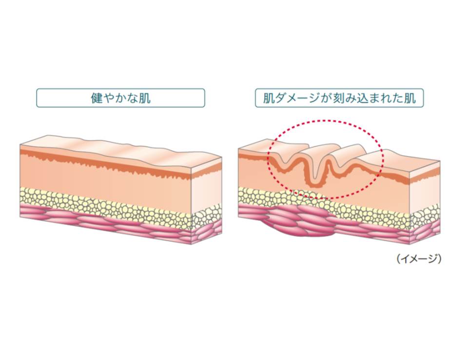 ドクターフィル コスメティクス　部分用集中ケア美容液「IC.U　アルジェックス」をリニューアル