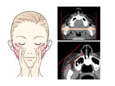 フェイシャルマッサージによるたるみ改善効果を実証　CT画像解析により筋膜と脂肪層の変化を確認